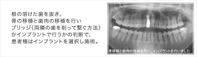 インプラント施術