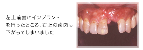 インプラント症例