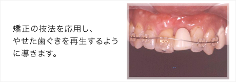 インプラント症例