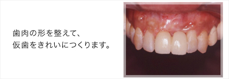 インプラント症例