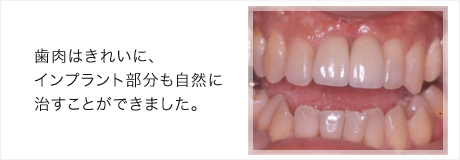 インプラント症例