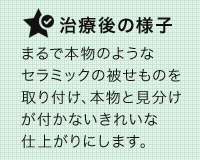 まるで本物のようなセラミックの被せものを取り付け、本物と見分けが付かないきれいな仕上がりにします。