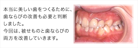 噛むたびに被せものが痛み、審美性の悪さに悩む患者様。本当に美しい歯をつくるために、歯ならびの改善も必要と判断しました。今回は、被せものと歯ならびの両方を改善していきます。