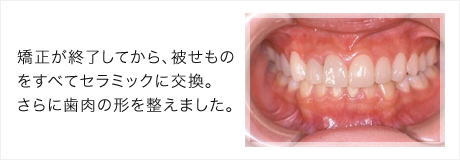 矯正が終了してから、被せものをすべてセラミックに交換。さらに歯肉の形を整えました。