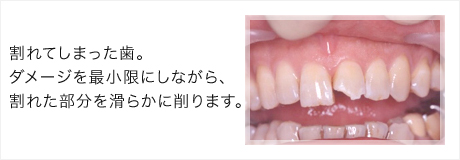 割れてしまった歯。ダメージを最小限にしながら、割れた部分を滑らかに削ります。