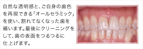 自然な透明感と、ご自身の歯色を再現できる「オールセラミック」を使い、割れてなくなった歯を補います。最後にクリーニングをして、歯の表面をつるつるに仕上げます。患者様も大満足の仕上がりです。