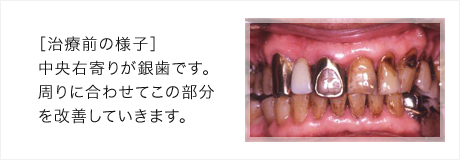 中央右寄りが銀歯です。周りに合わせてこの部分を改善していきます。