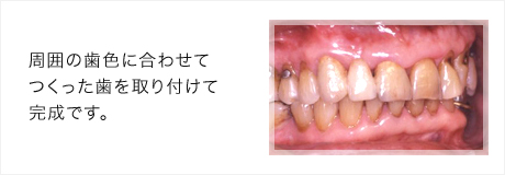 周囲の歯色に合わせてつくった歯を取り付けて完成です。