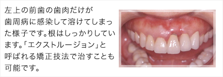左上の前歯の歯肉だけが歯周病に感染して溶けてしまった様子です。根はしっかりしています。「エクストルージョン」と呼ばれる矯正技法で治すことも可能です。