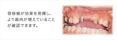 骨移植により歯肉が増えました！