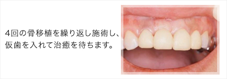 仮歯を入れて治癒を待ちます（4回の骨移植を繰り返しました）。