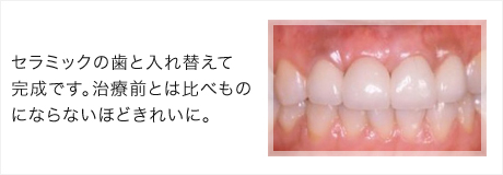 セラミックの歯と入れ替えて完成です。