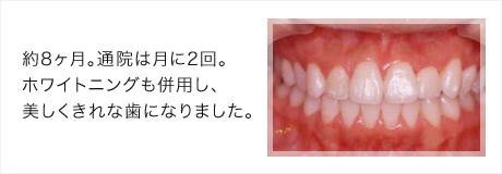 ホワイトニングとの併用できれいな口元に