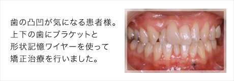 歯の凸凹が気になる患者様