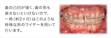 上下の歯にブラケットと形状記憶ワイヤーを施術