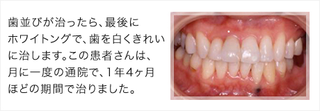 ホワイトニングとの併用できれいな口元に