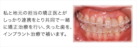 矯正とインプラント治療