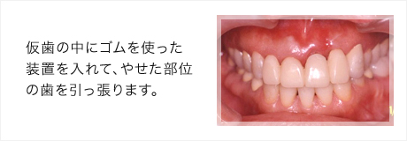 仮歯の中にゴムを使った装置を入れて、やせた部位の歯を引っ張ります。