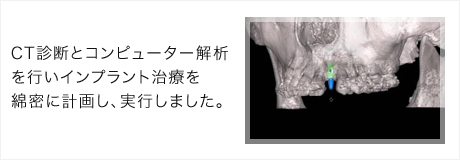 CT診断とコンピューター解析を行いインプラント治療を計画致しました。