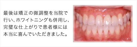 最後は矯正の微調整を当院で行い、ホワイトニングも行いました。完璧な仕上がりで本当に喜んでいただきました。