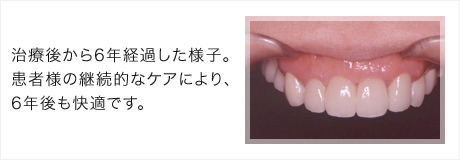 6年経っても審美が保たれた歯