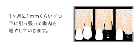 1ヶ月に1mmくらいずつ下に引っ張って歯肉を増やしていきます。