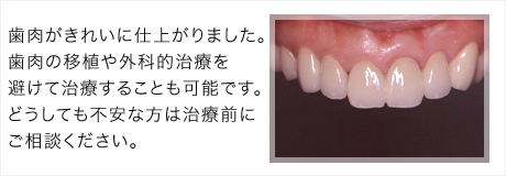 歯肉がきれいに仕上がりました。歯肉の移植や外科的治療を避けて治療することも可能です。どうしても不安な方はご相談ください。