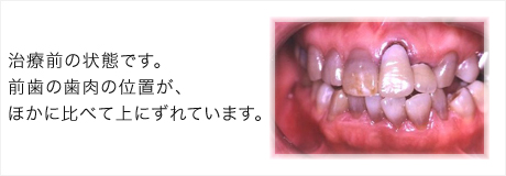 前歯の歯肉の位置が、ほかに比べて上にずれています。