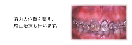 歯肉の位置を整え、矯正治療も行います。