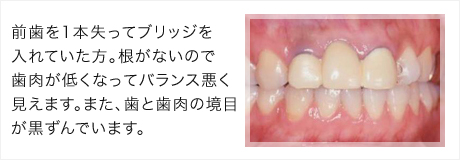 前歯を1本失ってブリッジを入れていた方。根がないので歯肉が低くなってバランス悪く見えます。また、歯と歯肉の境目が黒ずんでいます。