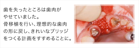歯を失ったところは歯肉がやせていました。骨移植を行い、理想的な歯肉の形に戻し、きれいなブリッジをつくる計画をすすめることに。