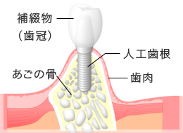 インプラントイメージ